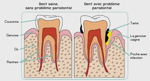 Parodontologie et maladie parodontale