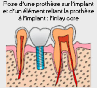 Schema de pose d'une prothese sur l'implant et de l'inlay core