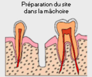 Preparation pour la pose de l'implant dentaire