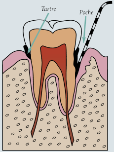 Traitement des maladies parodontale